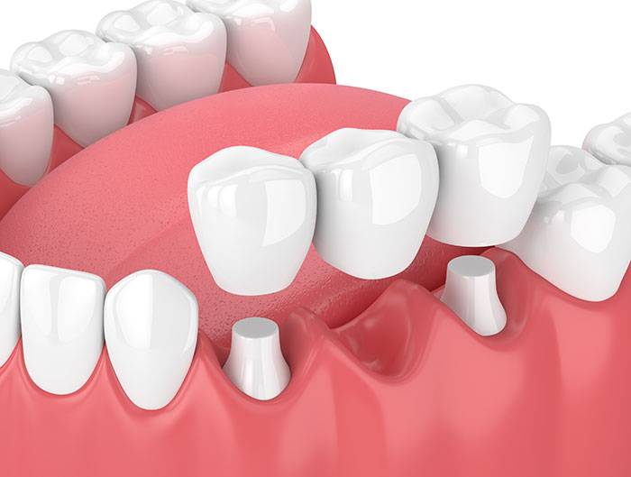 Dental Bridges Bruce Jones Dds