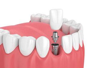 Dental Implants Muskegon Mi