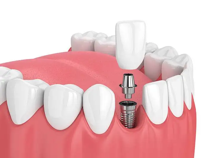 Dental Implants Muskegon Mi