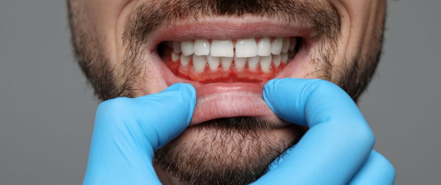 "How to Get Rid of Gingivitis Fast - Understanding Gingivitis Symptoms and Causes