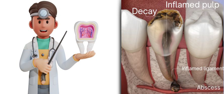 Stages of Tooth Decay
