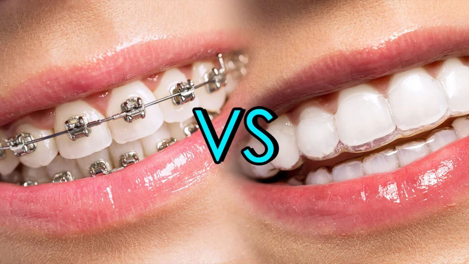 Braces vs Invisalign in Muskegon MI – orthodontic treatment comparison at Bruce Jones Dental